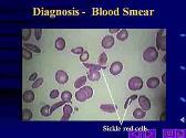 What is Sickle Cell Disease