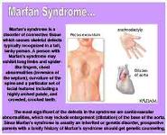 Birth defects PowerPoint Presentation