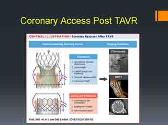 Tavr-Transcatheter Treatment of Aortic Stenosis Comes of Age