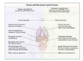 Cystic Fibrosis