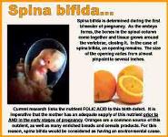 Birth Defects PowerPoint Presentation Notes