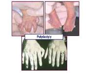 An Approach To Birth Defects-Perspectives in Dysmorphology PowerPoint Presentation