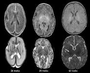 Late Preterm and Early Term Infants PowerPoint Presentation
