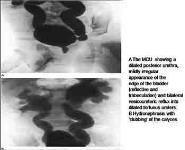 Urinary Tract Infection In Children PowerPoint Presentation