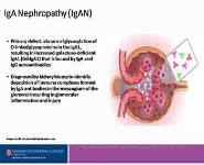 Iga Nephropathy-Igan PowerPoint Presentation