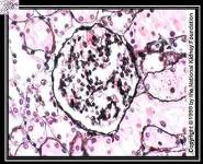 Secondary Causes of The Nephrotic Syndrome PowerPoint Presentation