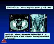 Stone Disease PowerPoint Presentation