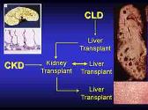 Systemic Hypertension and Renal Transplantation In Arpkd