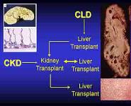 Systemic Hypertension and Renal Transplantation In Arpkd PowerPoint Presentation Notes