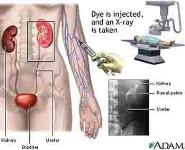 Urolithiasis PowerPoint Presentation Notes