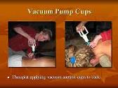 Cupping