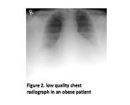 Obesity PowerPoint Presentation
