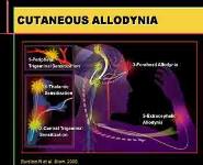 Migraine Overview PowerPoint Presentation