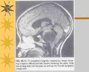 Brain Tumors In Pediatrics PowerPoint Presentation Notes