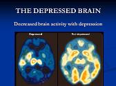 Depression-Its Symptoms Causes And Treatment