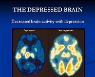 Depression-Its Symptoms Causes And Treatment PowerPoint Presentation Notes