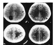 Seizures In Children PowerPoint Presentation