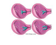 Management of Cervical Insufficiency PowerPoint Presentation