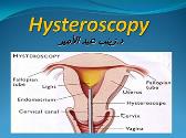 About Hysteroscopy