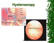 Infertility PowerPoint Presentation