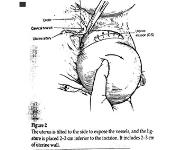 Maternal Mortality-Obstetrical Hemorrhage PowerPoint Presentation Notes