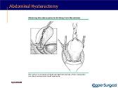 Hysterectomy