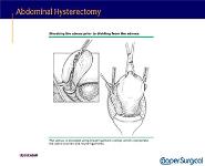 Hysterectomy PowerPoint Presentation