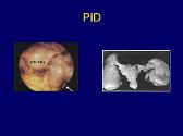 Pelvic Inflammatory Disease-PID