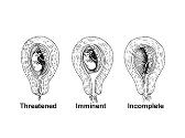Spontaneous Abortion