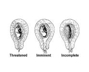 Spontaneous Abortion PowerPoint Presentation Notes