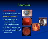 Mechanical Ocular Trauma PowerPoint Presentation Notes
