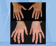 Osteoarthritis-Degenerative Joint Disease PowerPoint Presentation Notes