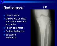 Bone And Soft Tissue Sarcomas PowerPoint Presentation