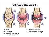 Osteoarthritis