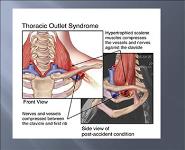 Thoracic Outlet Syndrome PowerPoint Presentation