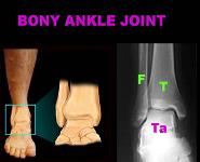 Ankle Sprains PowerPoint Presentation