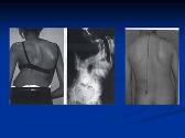 Approach To A Case of Scoliosis