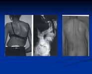 Approach To A Case of Scoliosis PowerPoint Presentation Notes