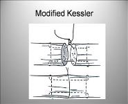 Flexor Tendon Repairs PowerPoint Presentation
