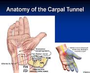 Carpal Tunnel Syndrome PowerPoint Presentation Notes