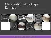 Cartilage Injury and Surgical Treatment