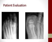 Diabetic Foot PowerPoint Presentation Notes