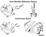 Acute Anterior Dislocation of The Shoulder PowerPoint Presentation