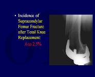 Treatment of Peri-Implant Fractures of The Femur PowerPoint Presentation Notes