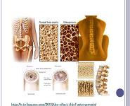 About Osteoporosis PowerPoint Presentation Notes