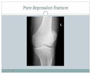 Plateau Tibial Fracture PowerPoint Presentation Notes