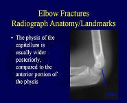 Fractures and Dislocations About The Elbow in The Pediatric Patient PowerPoint Presentation Notes