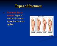 Principles of Fractures PowerPoint Presentation