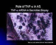 Seronegative Spondyloarthritides PowerPoint Presentation