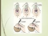 Endotracheal Intubation